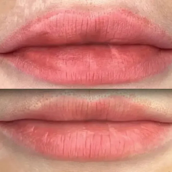 cosmetic tattoo removal preston
