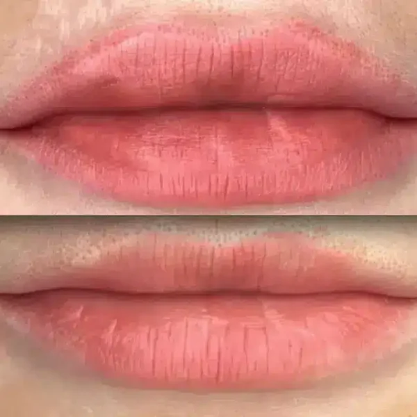 cosmetic tattoo removal preston