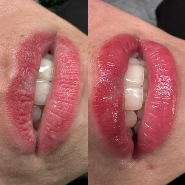 cosmetic tattoo removal