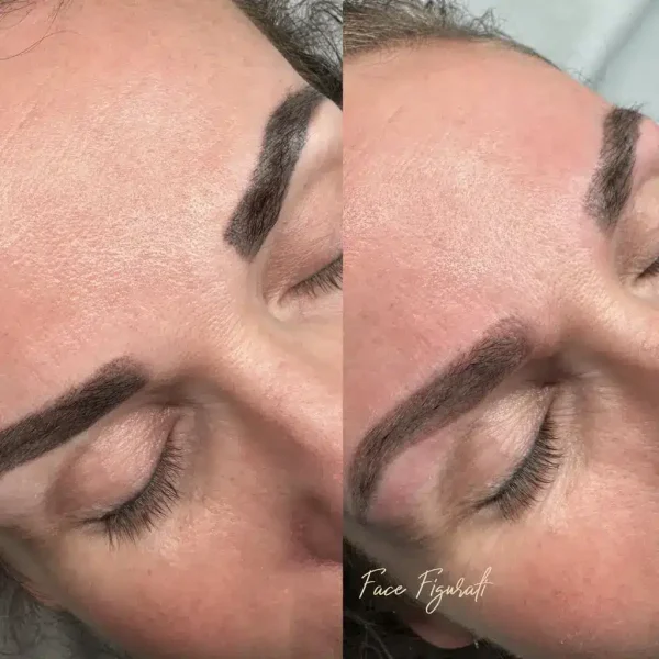 cosmetic tattoo removal