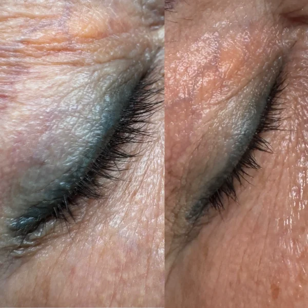 cosmetic tattoo removal south melbourne