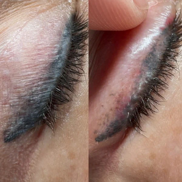 cosmetic tattoo removal south yarra