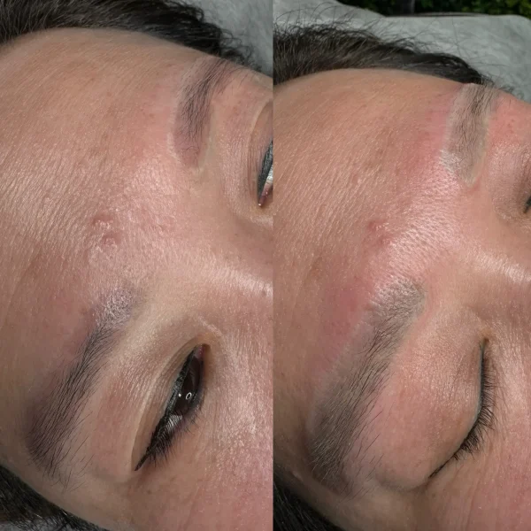 cosmetic tattoo removal st kilda