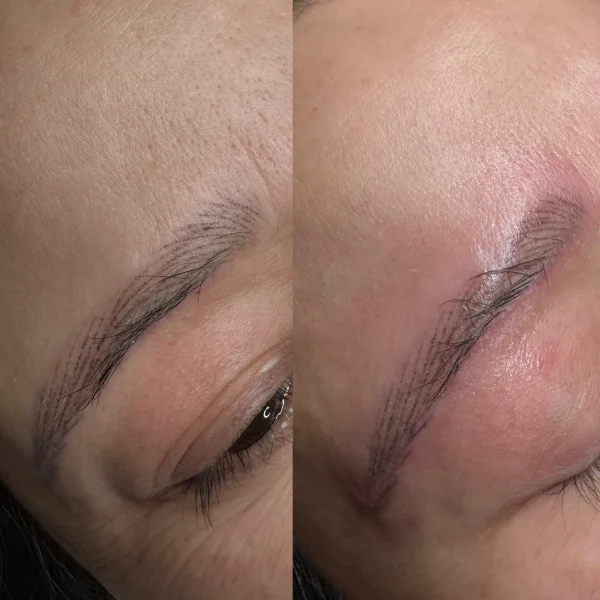 cosmetic tattoo removal yarraville