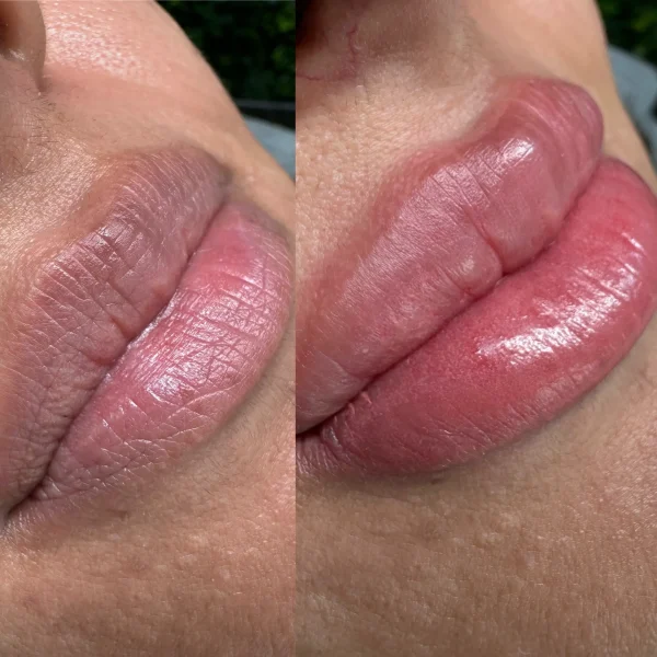 dark lip correction treatment cost in melbourne