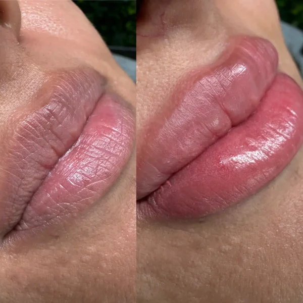 dark lip correction treatment cost in melbourne