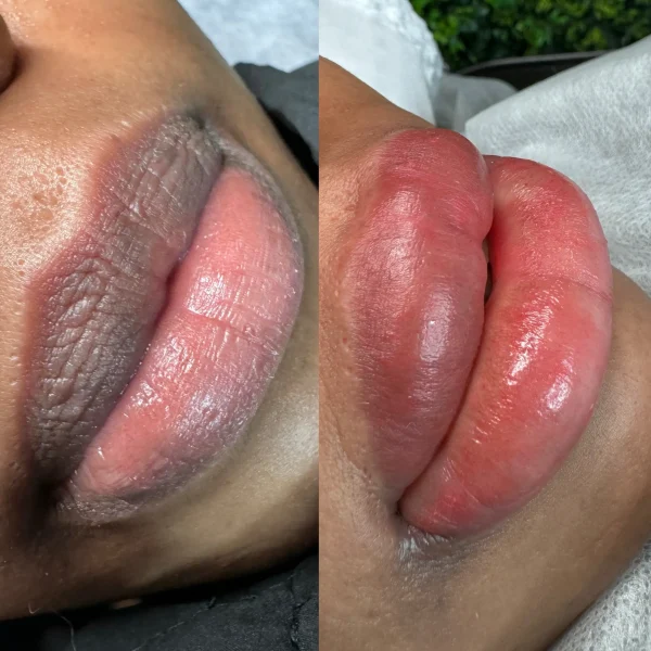 dark lip correction treatment in Melbourne