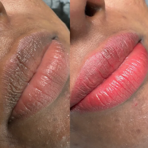 dark lip neutralisation melbourne