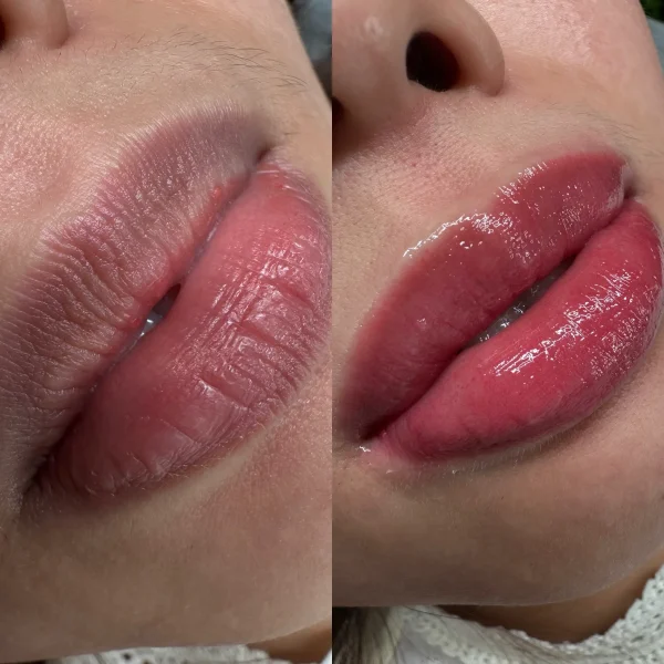 dark lip neutralization melbourne
