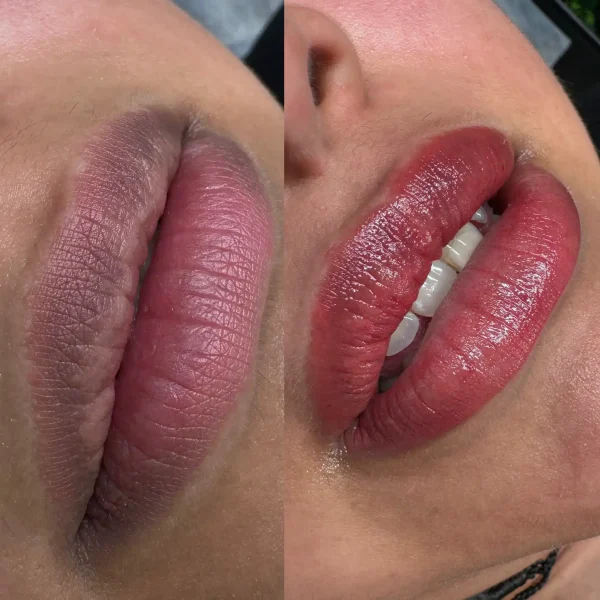 dark lip neutralization near me