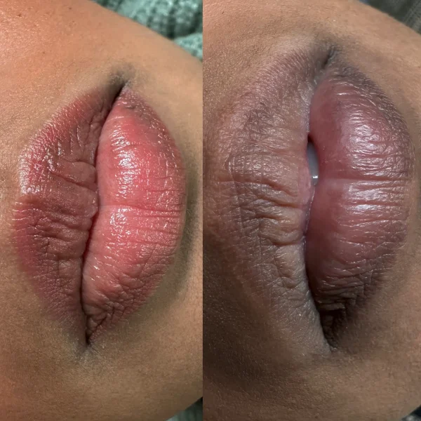 dark lip treatment