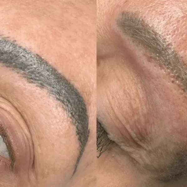 eyebrow laser removal