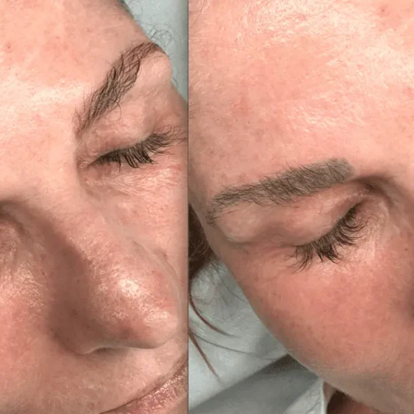 eyebrow tattoo laser removal
