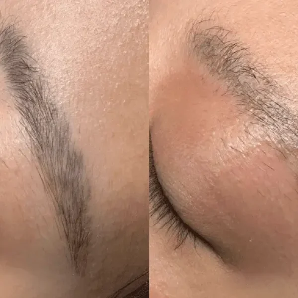 eyebrow tattoo removal near me
