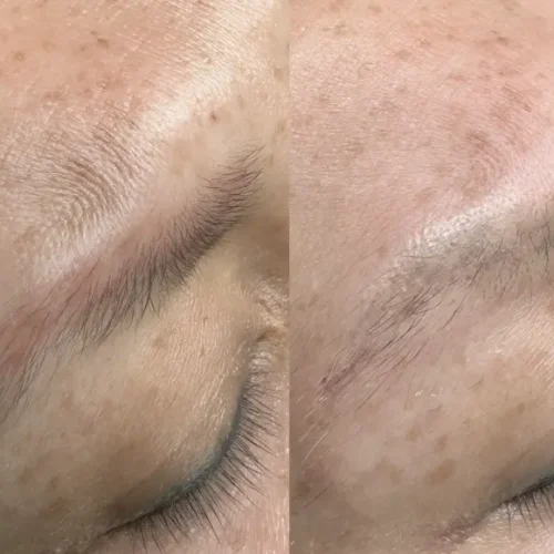 eyebrow tattoo removal saline