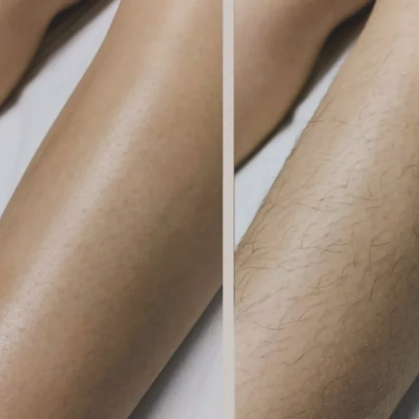 female full body laser