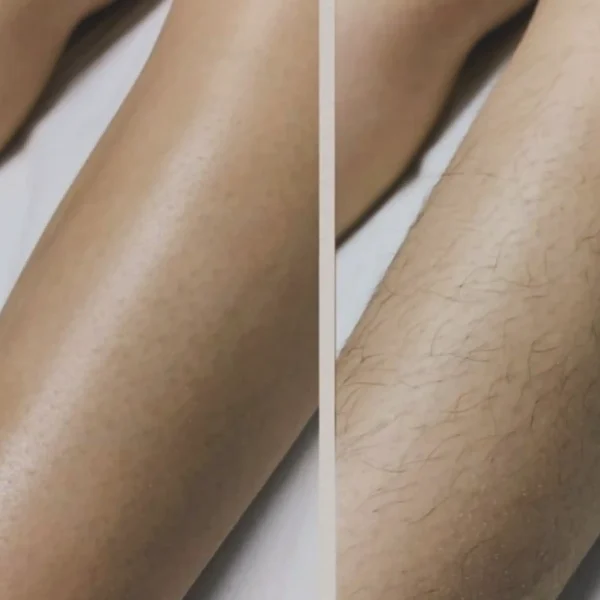 female full body laser