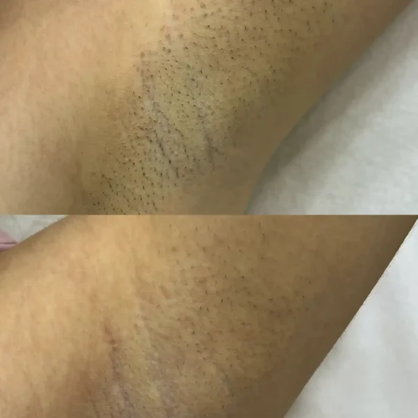 full body epilation