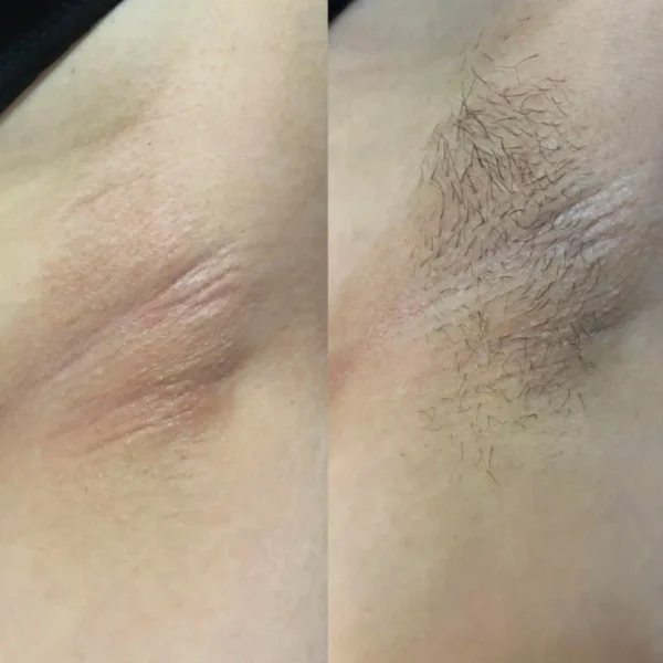 full body hair laser removal cost
