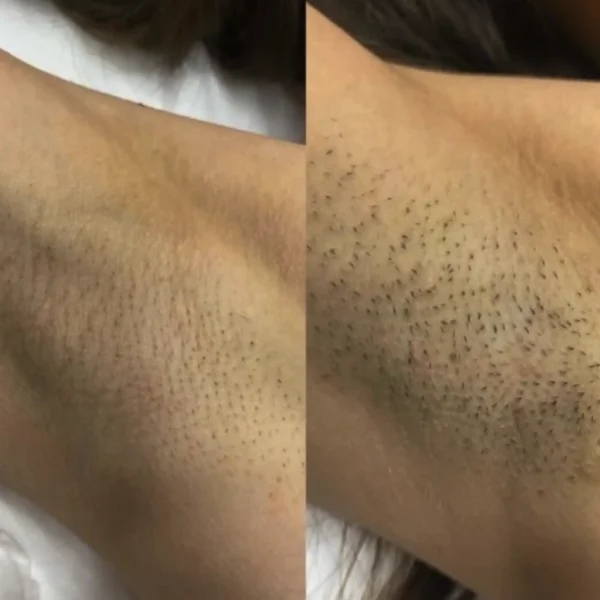 full body hair laser removal