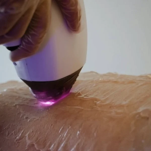 full body hair removal