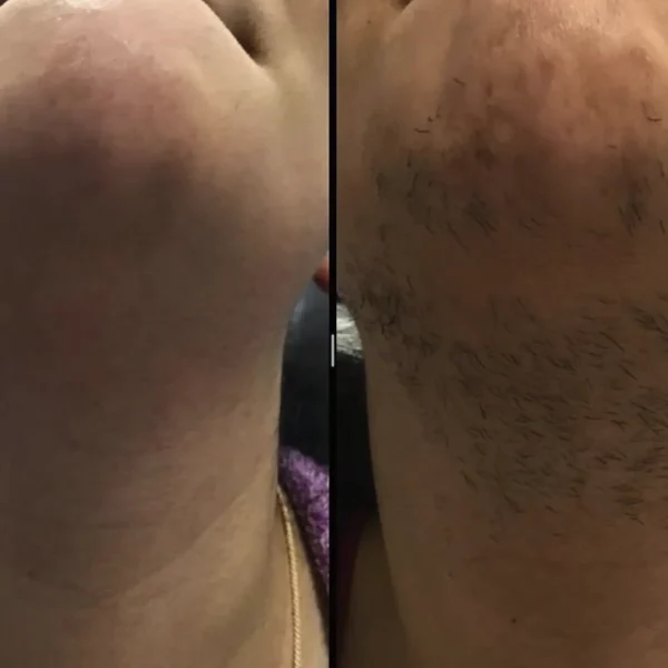 full body laser cost