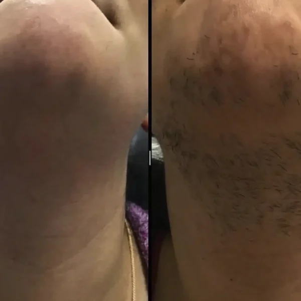 full body laser cost