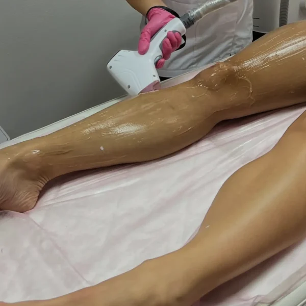 full body laser hair removal cost