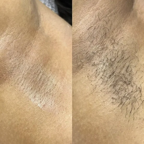 full body laser treatment