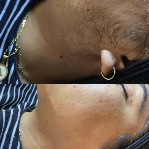 full body permanent hair removal