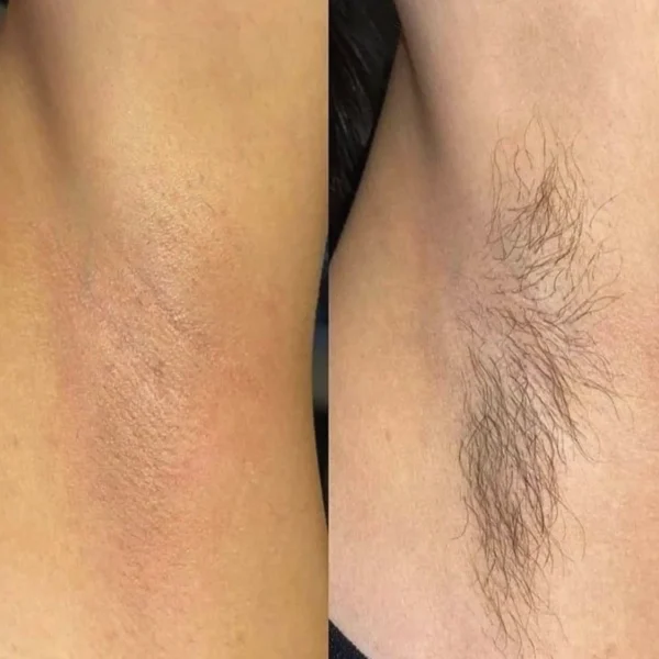 full face laser hair removal