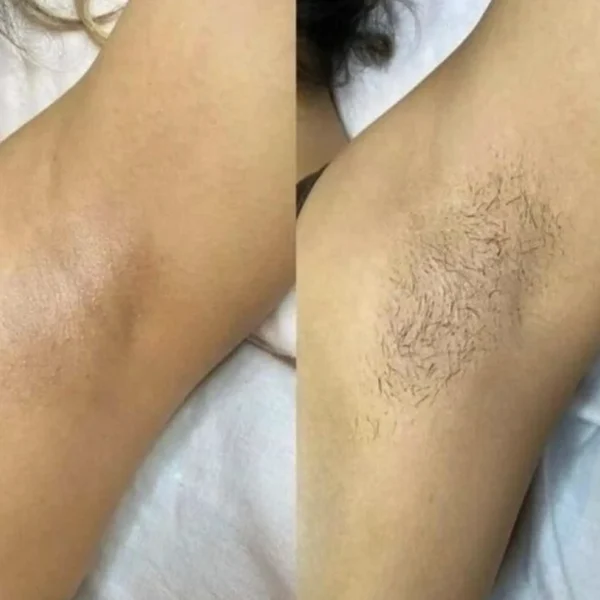 how long does a full body laser hair removal session take