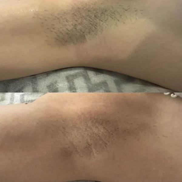 how long does a full body laser session take