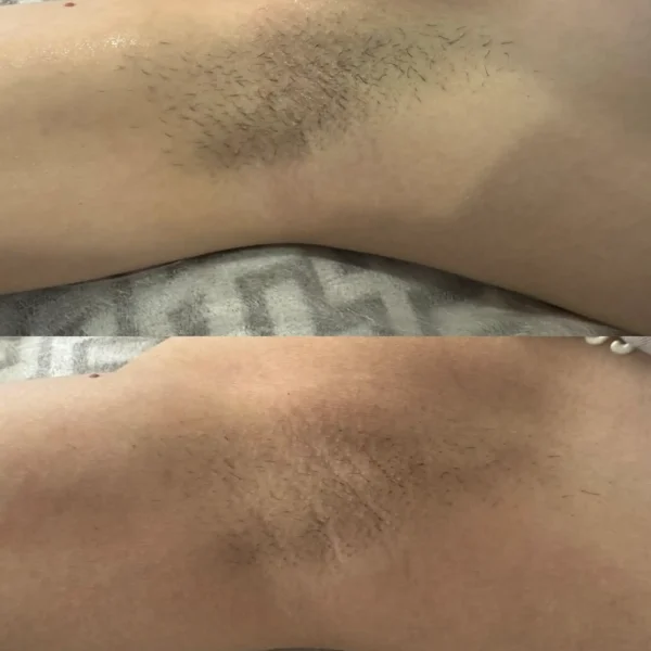 how long does full body laser hair removal take