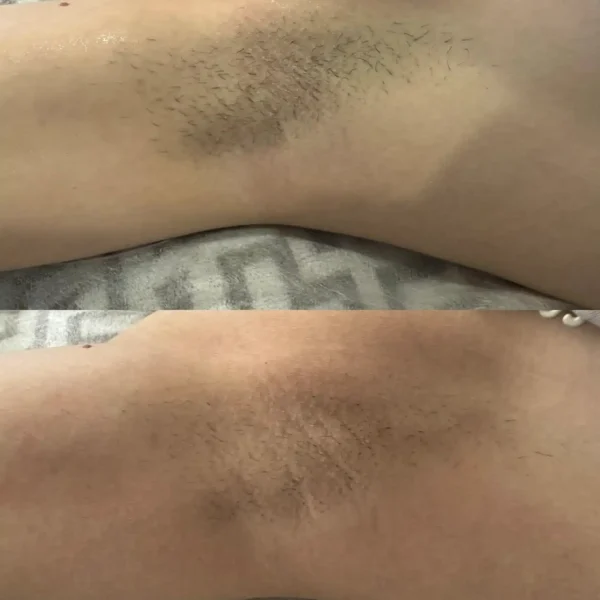 how long does full body laser hair removal take