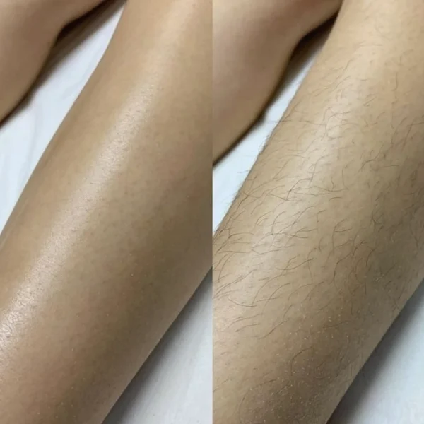 how long does full body laser take