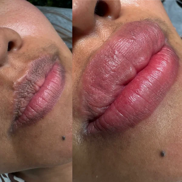 how much does lip neutralization cost in Melbourne