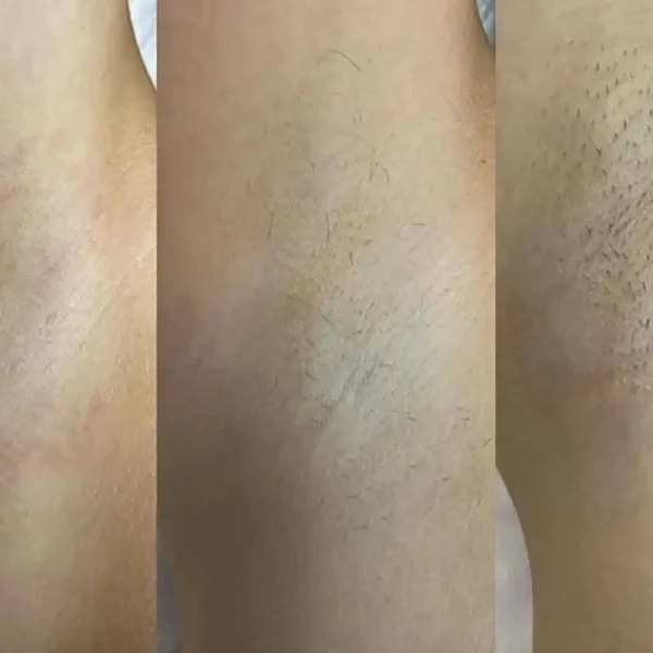 how much is full body laser hair removal