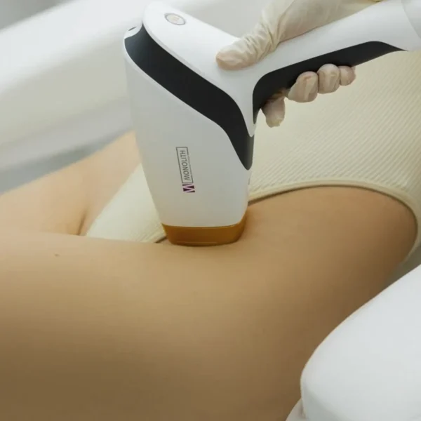 laser bikini hair removal