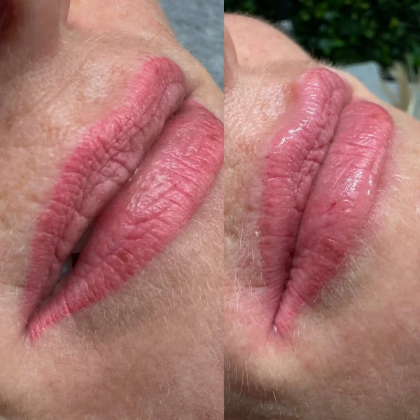 laser cosmetic tattoo removal