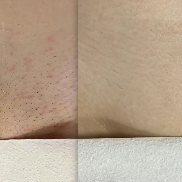 laser hair removal bikini area