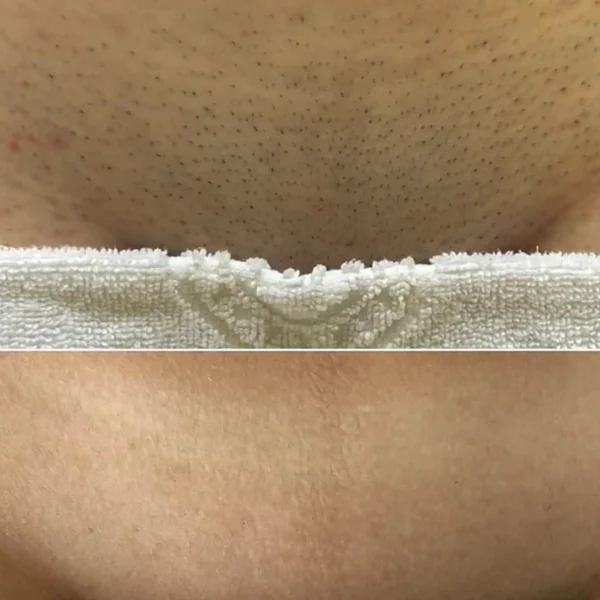 laser hair removal bikini