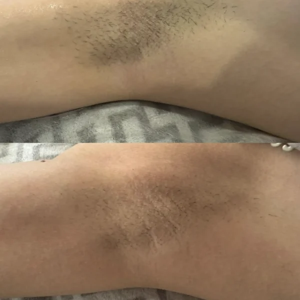 laser hair removal cost full body