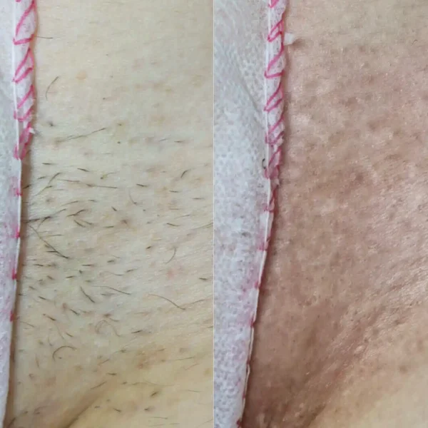 laser hair removal full bikini