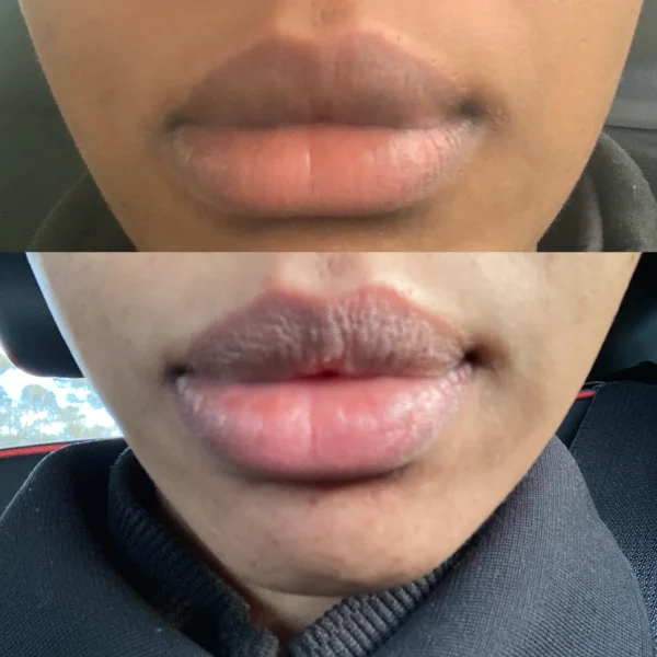 lip neutralisation cost melbourne