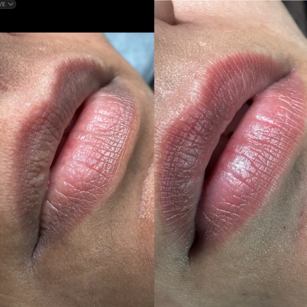 lip neutralisation in melbourne victoria