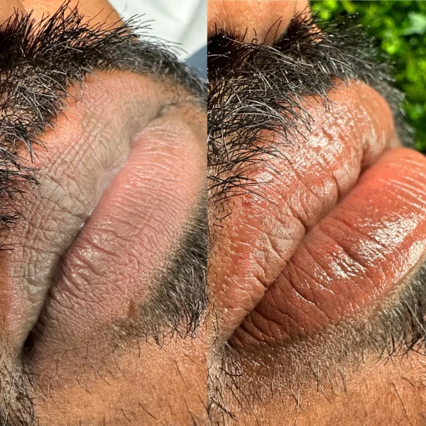 lip neutralisation near me