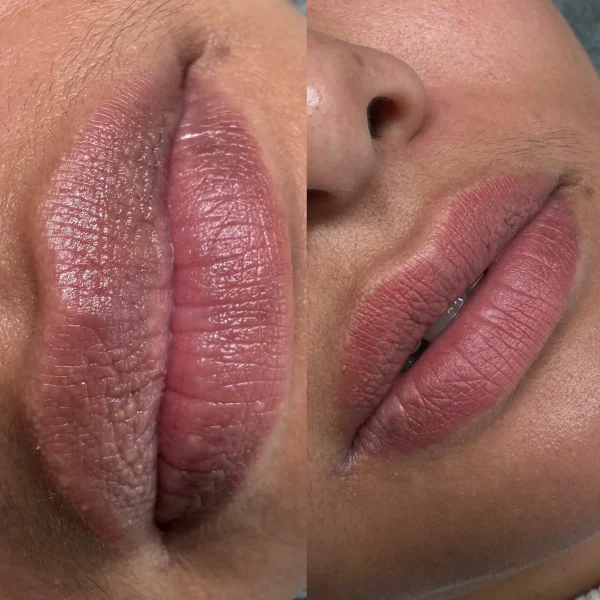 lip neutralization cost melbourne