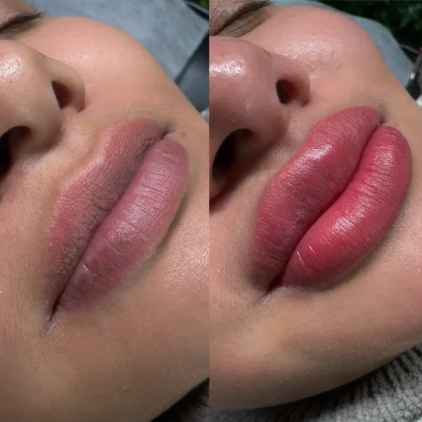 lip neutralization melbourne latest