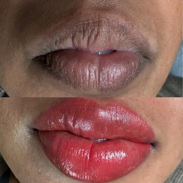 lip neutralization melbourne